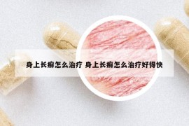 身上长癣怎么治疗 身上长癣怎么治疗好得快