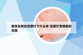 隐性白斑在伍德灯下什么样 伍德灯发现隐形白斑