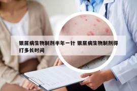 银屑病生物制剂半年一针 银屑病生物制剂得打多长时间