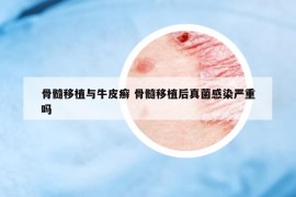 骨髓移植与牛皮癣 骨髓移植后真菌感染严重吗