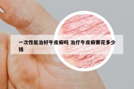 一次性能治好牛皮癣吗 治疗牛皮癣要花多少钱