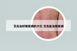 艾灸治好银屑病的穴位 艾灸能治银屑病
