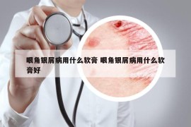 眼角银屑病用什么软膏 眼角银屑病用什么软膏好