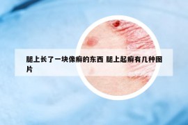 腿上长了一块像癣的东西 腿上起癣有几种图片