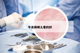 牛皮癣哪儿看的好