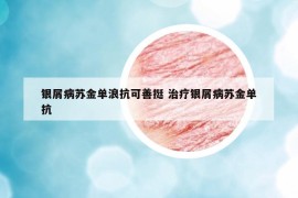 银屑病苏金单浪抗可善挺 治疗银屑病苏金单抗