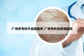广州市专科牛皮癣医院 广州专科皮肤病医院