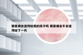 银屑病会遗传给我的孩子吗 银屑病会不会遗传给下一代