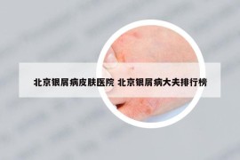 北京银屑病皮肤医院 北京银屑病大夫排行榜