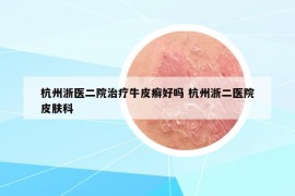 杭州浙医二院治疗牛皮癣好吗 杭州浙二医院皮肤科
