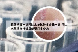 银屑病打一针阿达木单抗针多少钱一针 阿达木单抗治疗银屑病要打多少次