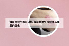 银屑病挂中医可以吗 银屑病看中医挂什么类型的医生