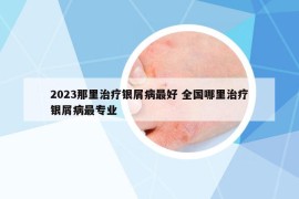 2023那里治疗银屑病最好 全国哪里治疗银屑病最专业