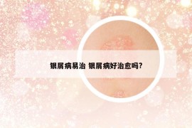 银屑病易治 银屑病好治愈吗?