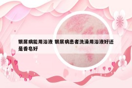 银屑病能用浴液 银屑病患者洗澡用浴液好还是香皂好
