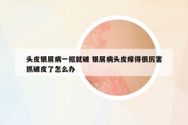 头皮银屑病一抠就破 银屑病头皮痒得很厉害抓破皮了怎么办