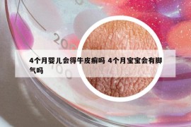 4个月婴儿会得牛皮癣吗 4个月宝宝会有脚气吗