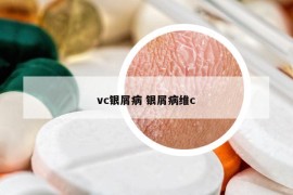 vc银屑病 银屑病维c
