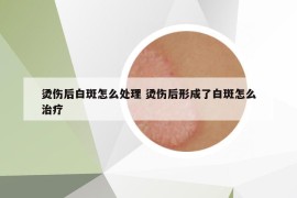 烫伤后白斑怎么处理 烫伤后形成了白斑怎么治疗