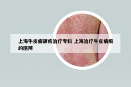 上海牛皮癣顽疾治疗专科 上海治疗牛皮病癣的医院
