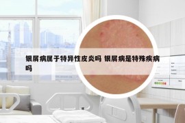 银屑病属于特异性皮炎吗 银屑病是特殊疾病吗