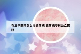 在三甲医院怎么治银屑病 银屑病专科公立医院