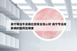 南宁哪治牛皮癣比较安全放心好 南宁专治皮肤病的医院在哪里
