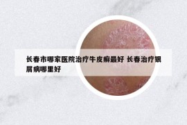 长春市哪家医院治疗牛皮癣最好 长春治疗银屑病哪里好