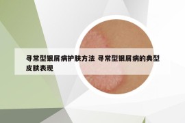 寻常型银屑病护肤方法 寻常型银屑病的典型皮肤表现