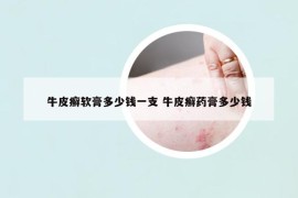 牛皮癣软膏多少钱一支 牛皮癣药膏多少钱