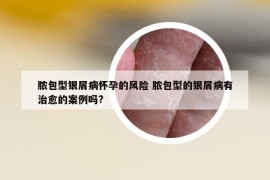 脓包型银屑病怀孕的风险 脓包型的银屑病有治愈的案例吗?