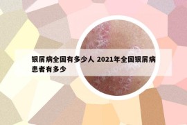 银屑病全国有多少人 2021年全国银屑病患者有多少