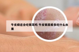 牛皮癣适合吃银耳吗 牛皮银屑癣多吃什么水果