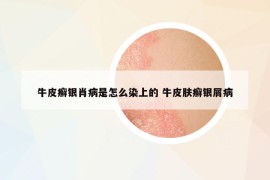 牛皮癣银肖病是怎么染上的 牛皮肤癣银屑病