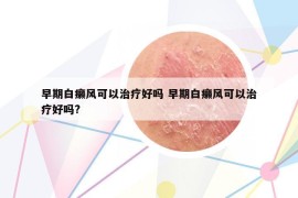 早期白癞风可以治疗好吗 早期白癞风可以治疗好吗?