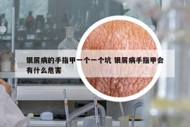 银屑病的手指甲一个一个坑 银屑病手指甲会有什么危害