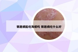 银翘病能吃海螺吗 银翘病吃什么好