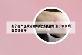 南宁哪个医院治银屑病效果最好 南宁银屑病医院哪里好