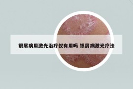 银屑病用激光治疗仪有用吗 银屑病激光疗法