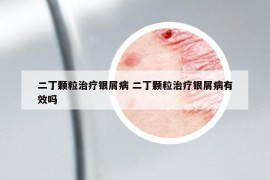 二丁颗粒治疗银屑病 二丁颗粒治疗银屑病有效吗