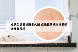 点状型银屑病斑多久消 点状银屑病治疗期间会反复发吗