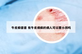 牛皮癣婆婆 有牛皮病癣的病人可以要小孩吗