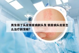 男生得了头皮银屑病剃头发 银屑病头皮屑怎么治疗剃发嘛?