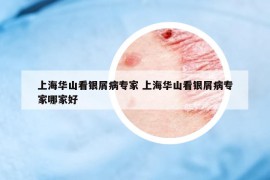 上海华山看银屑病专家 上海华山看银屑病专家哪家好