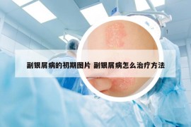 副银屑病的初期图片 副银屑病怎么治疗方法