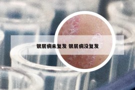 银屑病未复发 银屑病没复发