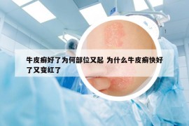 牛皮癣好了为何部位又起 为什么牛皮癣快好了又变红了