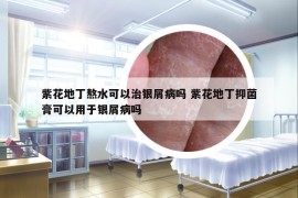 紫花地丁熬水可以治银屑病吗 紫花地丁抑菌膏可以用于银屑病吗