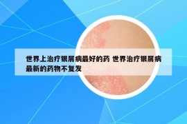 世界上治疗银屑病最好的药 世界治疗银屑病最新的药物不复发