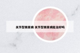 关节型银屑病 关节型银屑病能治好吗